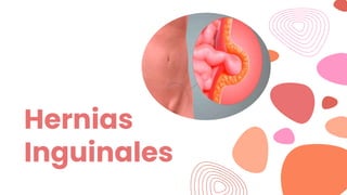Hernias
Inguinales
 