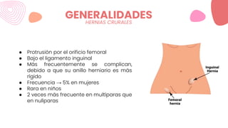 GENERALIDADES
● Protrusión por el orificio femoral
● Bajo el ligamento inguinal
● Más frecuentemente se complican,
debido a que su anillo herniario es más
rígido
● Frecuencia → 5% en mujeres
● Rara en niños
● 2 veces más frecuente en multíparas que
en nulíparas
HERNIAS CRURALES
 