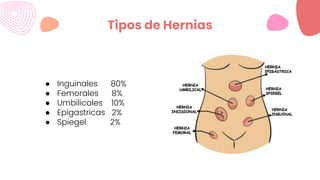 Tipos de Hernias
● Inguinales 80%
● Femorales 8%
● Umbilicales 10%
● Epigastricas 2%
● Spiegel 2%
 