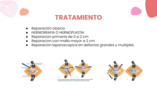 TRATAMIENTO
● Reparación clasica
● HERNIORRAFIA O HERNIOPLASTIA
● Reparacion primaria de 0 a 2 cm
● Reparacion con malla mayor a 2 cm
● Reparacion laparoscopica en defectos grandes y multiples.
 