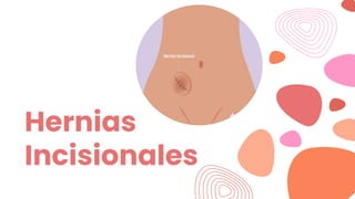 Hernias
Incisionales
 