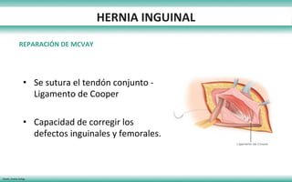 Mcvay Incision Hernias pared abdominal 2017 (Hernia Inguinal/Hernia femoral) | PDF