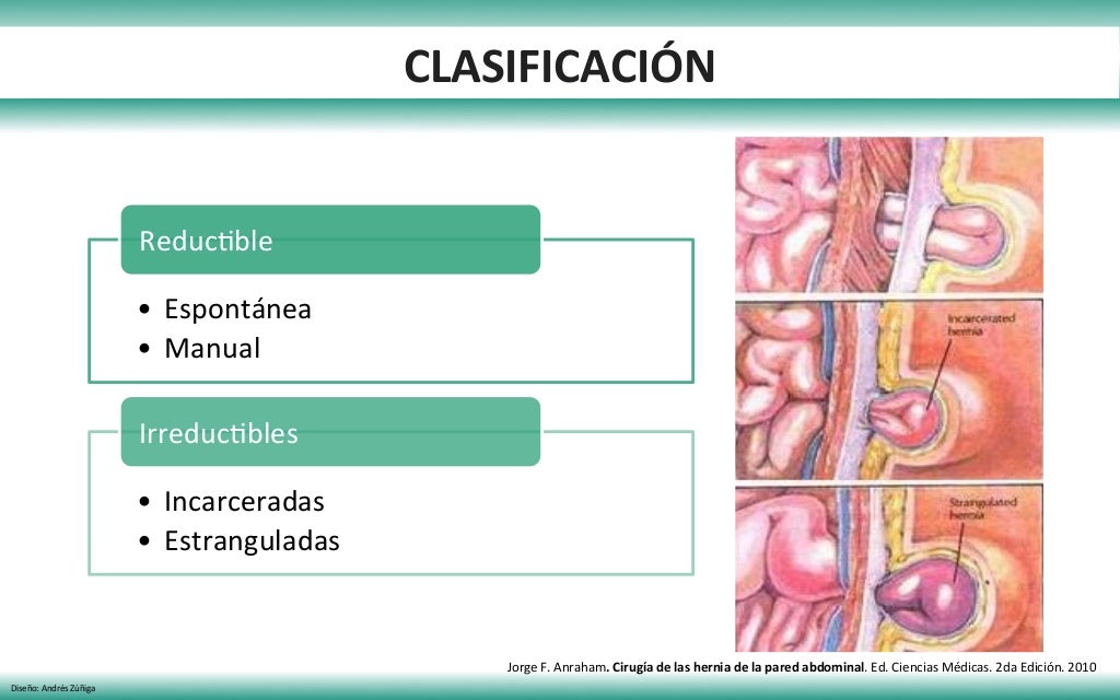 Hernias pared abdominal 2017 (Hernia Inguinal/Hernia femoral)