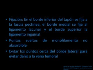 • Fijación: En el borde inferior del tapón se fija a
la fascia pectínea, el borde medial se fija al
ligamento lacunar y el borde superior la
ligamento inguinal
• Puntos sueltos de monofilamento no
absorbible
• Evitar los puntos cerca del borde lateral para
evitar daño a la vena femoral
Hernias de la pared abdominal. Tratamiento actual.
2da edición 2009. Mayagoitia. Sección V Hernias poco
comunes
 