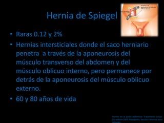 Hernia de Spiegel
• Raras 0.12 y 2%
• Hernias intersticiales donde el saco herniario
penetra a través de la aponeurosis del
músculo transverso del abdomen y del
músculo oblicuo interno, pero permanece por
detrás de la aponeurosis del músculo oblicuo
externo.
• 60 y 80 años de vida
Hernias de la pared abdominal. Tratamiento actual.
2da edición 2009. Mayagoitia. Sección V Hernias poco
comunes
 