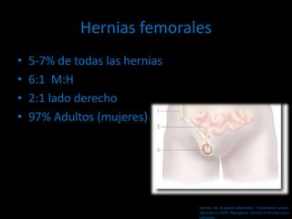 Hernias femorales
• 5-7% de todas las hernias
• 6:1 M:H
• 2:1 lado derecho
• 97% Adultos (mujeres)
Hernias de la pared abdominal. Tratamiento actual.
2da edición 2009. Mayagoitia. Sección V Hernias poco
comunes
 