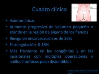 Cuadro clínico
• Asintomáticas
• Aumento progresivo de volumen pequeño o
grande en la región de alguno de los flancos
• Riesgo de encarceración es de 25%
• Estrangulación 8-18%
• Más frecuente en las congénitas y en las
incisionales con múltiples operaciones y
anillos fibróticos poco distendibles
Hernias de la pared abdominal. Tratamiento actual.
2da edición 2009. Mayagoitia. Sección V Hernias poco
comunes
 