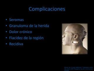 Complicaciones
• Seromas
• Granuloma de la herida
• Dolor crónico
• Flacidez de la región
• Recidiva
Hernias de la pared abdominal. Tratamiento actual.
2da edición 2009. Mayagoitia. Sección V Hernias poco
comunes
 