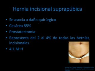 Hernia incisional suprapúbica
• Se asocia a daño quirúrgico
• Cesárea 85%
• Prostatectomía
• Representa del 2 al 4% de todas las hernias
incisionales
• 4:1 M:H
Hernias de la pared abdominal. Tratamiento actual.
2da edición 2009. Mayagoitia. Sección V Hernias poco
comunes
 