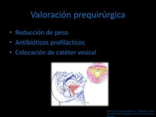 Valoración prequirúrgica
• Reducción de peso
• Antibióticos profilácticos
• Colocación de catéter vesical
Hernias de la pared abdominal. Tratamiento actual.
2da edición 2009. Mayagoitia. Sección V Hernias poco
comunes
 