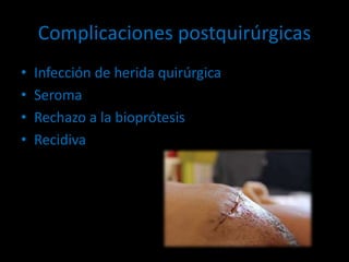 Complicaciones postquirúrgicas
• Infección de herida quirúrgica
• Seroma
• Rechazo a la bioprótesis
• Recidiva
 