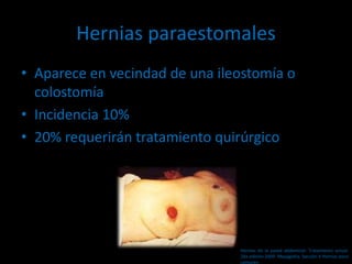 Hernias paraestomales
• Aparece en vecindad de una ileostomía o
colostomía
• Incidencia 10%
• 20% requerirán tratamiento quirúrgico
Hernias de la pared abdominal. Tratamiento actual.
2da edición 2009. Mayagoitia. Sección V Hernias poco
comunes
 