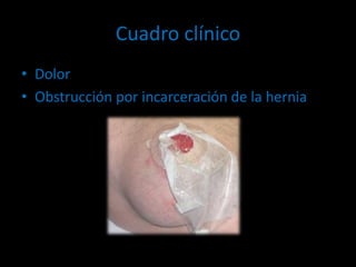 Cuadro clínico
• Dolor
• Obstrucción por incarceración de la hernia
 