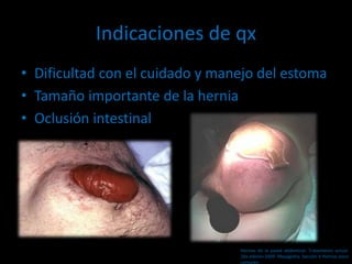 Indicaciones de qx
• Dificultad con el cuidado y manejo del estoma
• Tamaño importante de la hernia
• Oclusión intestinal
Hernias de la pared abdominal. Tratamiento actual.
2da edición 2009. Mayagoitia. Sección V Hernias poco
comunes
 
