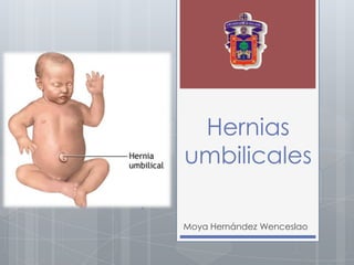 Hernias
umbilicales

Moya Hernández Wenceslao
 