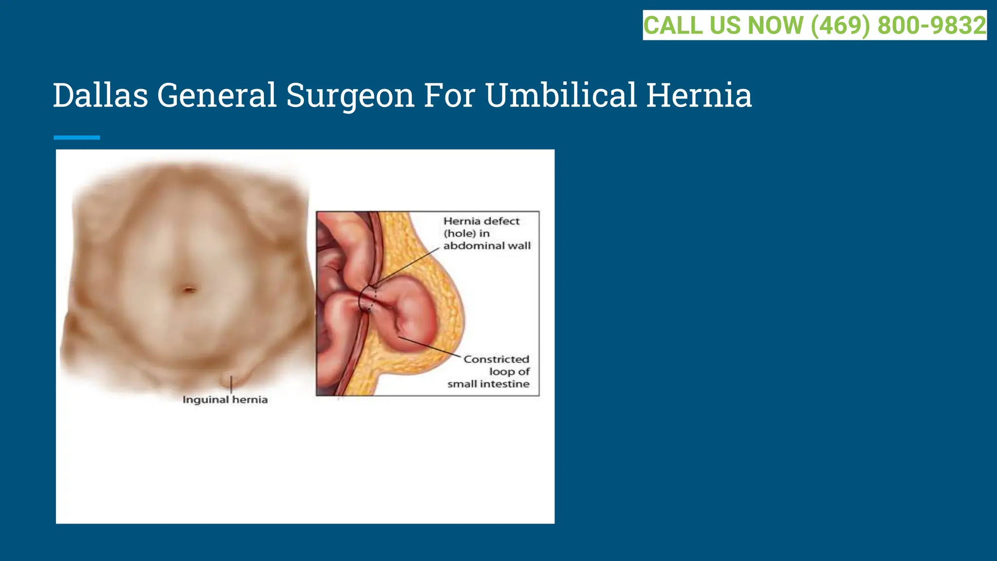 Dallas General Surgeon For Umbilical Hernia
CALL US NOW (469) 800-9832
 