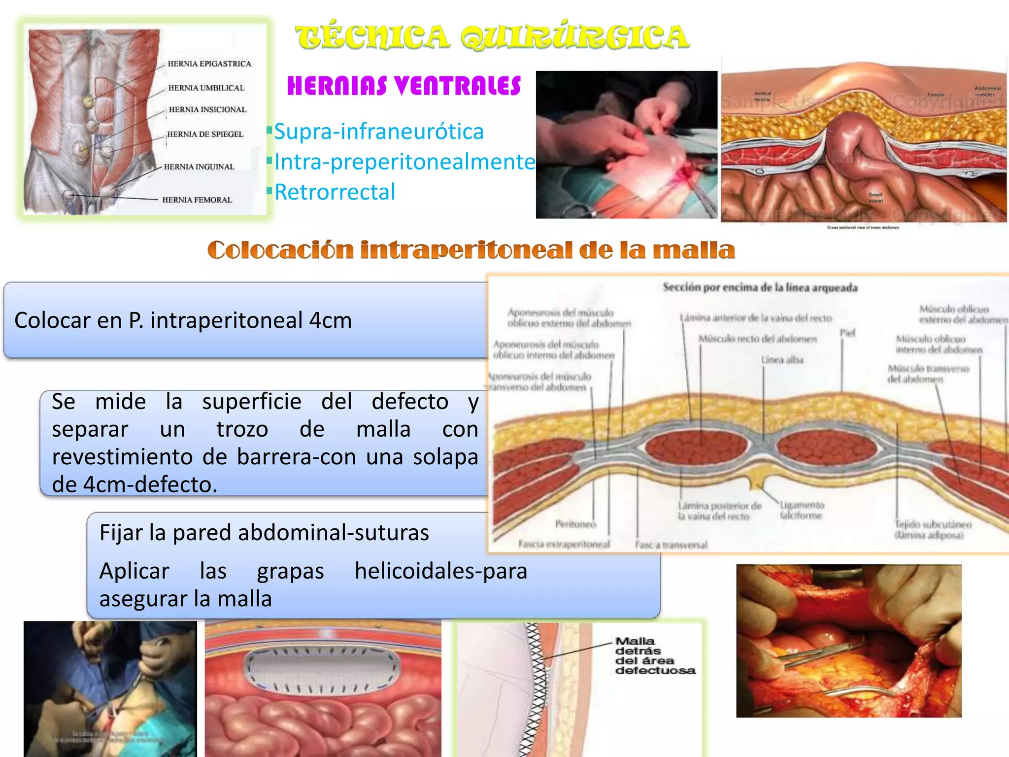 HERNIAS DE LA PARED ABDOMINAL | PPTX