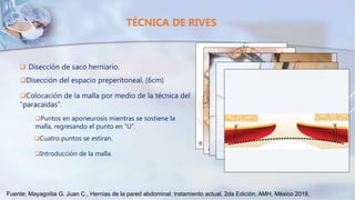  Disección de saco herniario.
TÉCNICA DE RIVES
Disección del espacio preperitoneal. (6cm)
Colocación de la malla por medio de la técnica del
“paracaídas”.
Puntos en aponeurosis mientras se sostiene la
malla, regresando el punto en “U”.
Cuatro puntos se estiran.
Introducción de la malla.
Fuente: Mayagoitia G. Juan C., Hernias de la pared abdominal; tratamiento actual, 2da Edición, AMH, México 2019,
 