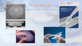 TÉCNICA PHS Y UHS
 