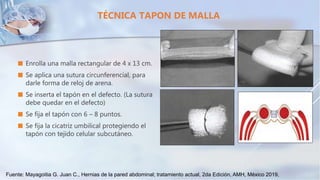  Enrolla una malla rectangular de 4 x 13 cm.
 Se aplica una sutura circunferencial, para
darle forma de reloj de arena.
 Se inserta el tapón en el defecto. (La sutura
debe quedar en el defecto)
 Se fija el tapón con 6 – 8 puntos.
 Se fija la cicatriz umbilical protegiendo el
tapón con tejido celular subcutáneo.
TÉCNICA TAPON DE MALLA
Fuente: Mayagoitia G. Juan C., Hernias de la pared abdominal; tratamiento actual, 2da Edición, AMH, México 2019,
 