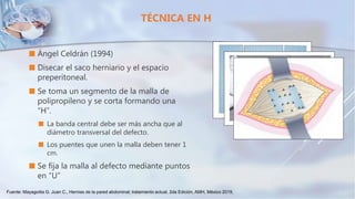  Ángel Celdrán (1994)
 Disecar el saco herniario y el espacio
preperitoneal.
 Se toma un segmento de la malla de
polipropileno y se corta formando una
“H”.
 La banda central debe ser más ancha que al
diámetro transversal del defecto.
 Los puentes que unen la malla deben tener 1
cm.
 Se fija la malla al defecto mediante puntos
en “U”
TÉCNICA EN H
Fuente: Mayagoitia G. Juan C., Hernias de la pared abdominal; tratamiento actual, 2da Edición, AMH, México 2019,
 