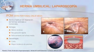 HERNIA UMBILICAL: LAPAROSCOPÍA
IPOM (INTRA PERITONEAL ONLAY MESH)
 Técnica habitual de reparación
de hernias ventrales e
incisionales.
 Ventajas:
 Menor recidivas.
 Recuperación rápida.
 Reforzamiento de la línea media.
 Desventajas:
 Costo.
 Mayor incidencia de seromas.
Ricardo A. Torres. El arte de la cirugía laparoscópica , Hernias de la pared abdominal; 1ra Edición, AMOLCA, 2011,
 