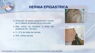 HERNIA EPIGASTRICA
 Protrusión de grasa preperitoneal a través
de un defecto localizado en la línea alba.
 Más común en hombres, y entre las
edades de 20 – 50 años.
 3 – 5 % de todas las hernias
 20%: Varias hernias
Fuente: Mayagoitia G. Juan C., Hernias de la pared abdominal; tratamiento actual, 2da Edición, AMH, México 2009,
 