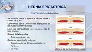 HERNIA EPIGASTRICA
ANATOMÍA DE LA LÍNEA ALBA
 Se extiende desde el apéndice xifoides hasta la
sínfisis del pubis.
 Conformada por la unión de las aponeurosis de
los músculos anterolaterales.
 Las hojas aponeuróticas se decusan con las del
lado opuesto.
 Delante de la línea alba:
 Tejido subcutáneo y piel.
 Detrás, de superficial a profundo:
 Grasa preperitoneal del ligamento falciforme.
 Peritoneo.
 Vísceras.
 
