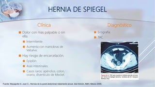 Clínica
 Dolor con mas palpable o sin
ella.
 Intermitente.
 Aumenta con maniobras de
Valsalva.
 Hay riesgo de encarcelación.
 Epiplón
 Asas intestinales.
 Casos raros: apéndice, colon,
ovario, divertículo de Meckel.
Diagnóstico
 Ecografía.
 TAC.
HERNIA DE SPIEGEL
Fuente: Mayagoitia G. Juan C., Hernias de la pared abdominal; tratamiento actual, 2da Edición, AMH, México 2009,
 