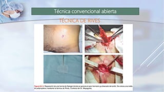 Técnica convencional abierta
TÉCNICA DE RIVES
 