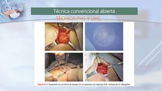 Técnica convencional abierta
TÉCNICA PHS Y UHS
 