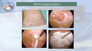 Técnica laparoscópica
IPOM (INTRA PERITONEAL ONLAY MESH)
 