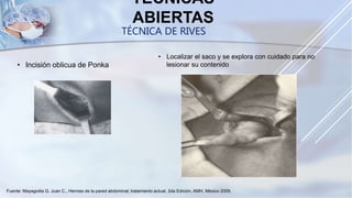 TÉCNICAS
ABIERTAS
• Incisión oblicua de Ponka
• Localizar el saco y se explora con cuidado para no
lesionar su contenido
TÉCNICA DE RIVES
Fuente: Mayagoitia G. Juan C., Hernias de la pared abdominal; tratamiento actual, 2da Edición, AMH, México 2009,
 