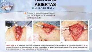  Disecar el espacio preperitoneal
con un margen de 8 cm de los
bordes del anillo.
TÉCNICAS
ABIERTAS
TÉCNICA DE RIVES
 