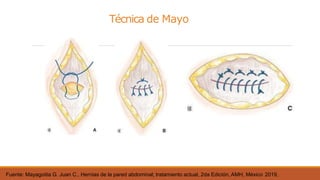 Técnica de Mayo
Fuente: Mayagoitia G. Juan C., Hernias de la pared abdominal; tratamiento actual, 2da Edición, AMH, México 2019,
 