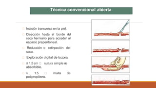 Incisión transversa en la piel.
Disección hasta el borde del
saco herniario para acceder al
espacio preperitoneal.
Reducción o extirpación del
saco.
Exploración digital de la zona.
≤ 1.5 cm sutura simple n
o
absorbible.
> 1.5 malla de
polipropileno.
Técnica convencional abierta
 