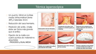 Técnica laparoscópica
Un puerto 10mmen la línea
media Infraumbilical (lente
30º),2 laterales 5mm
Reducción del saco herniario.
Medición del anillo. (malla
debe ser 5cms más grande
que el anillo)
Fijación de la malla con
cuatro puntos de materialno
absorbible
PROCEED y DUAL MESH
 
