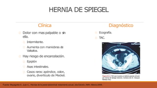 Clínica
Dolor con mas palpable o sin
ella.
Intermitente.
Aumenta con maniobras de
Valsalva.
Hay riesgo de encarcelación.
Epiplón
Asas intestinales.
Casos raros:apéndice, colon,
ovario, divertículo de Meckel.
Fuente: Mayagoitia G. Juan C., Hernias de la pared abdominal; tratamiento actual, 2da Edición, AMH, México2009,
Diagnóstico
Ecografía.
TAC.
HERNIA DE SPIEGEL
 