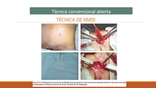Técnica convencional abierta
TÉCNICA DE RIVES
 