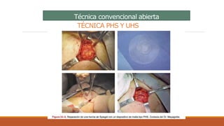 Técnica convencional abierta
TÉCNICA PHS Y UHS
 
