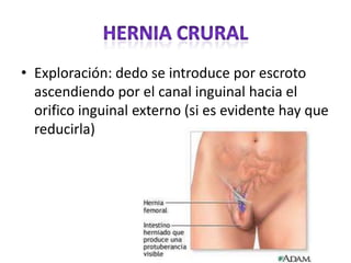 • Exploración: dedo se introduce por escroto
ascendiendo por el canal inguinal hacia el
orifico inguinal externo (si es evidente hay que
reducirla)
 