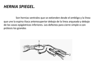 HERNIA SPIEGEL.
Son hernias ventrales que se extienden desde el ombligo y la línea
que une la espina iliaca anterosuperior debajo de la linea arqueada y debajo
de los vasos epigástricos inferiores. Los defectos para cierre simple o con
prótesis los grandes
 
