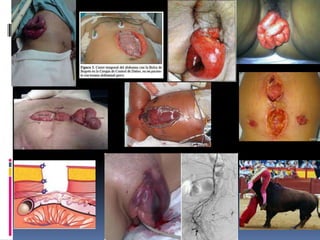 Hernias y eventraciones ii