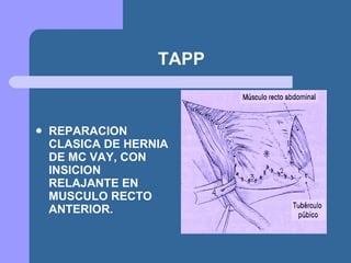 TAPP REPARACION CLASICA DE HERNIA DE MC VAY, CON INSICION RELAJANTE EN MUSCULO RECTO ANTERIOR. 