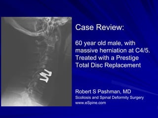 Case Review:
60 year old male, with
massive herniation at C4/5.
Treated with a Prestige
Total Disc Replacement



Robert S Pashman, MD
Scoliosis and Spinal Deformity Surgery
www.eSpine.com
 
