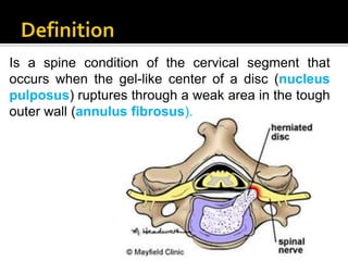 Herniated cervical disc | PPTX