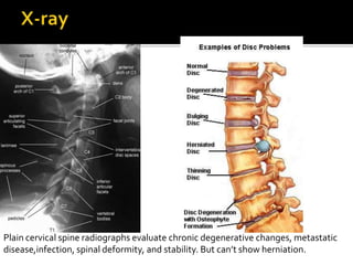 Herniated cervical disc | PPTX