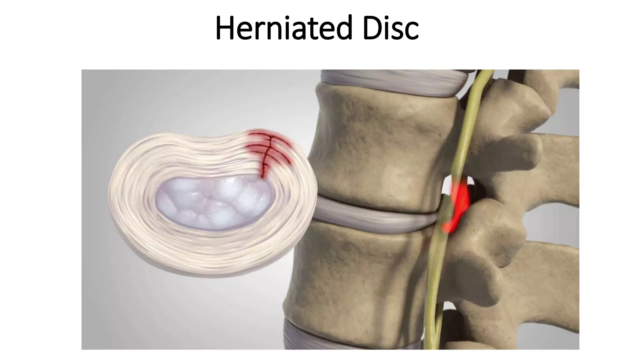 Ayurvedic Treatment for Herniated Disc | PPTX