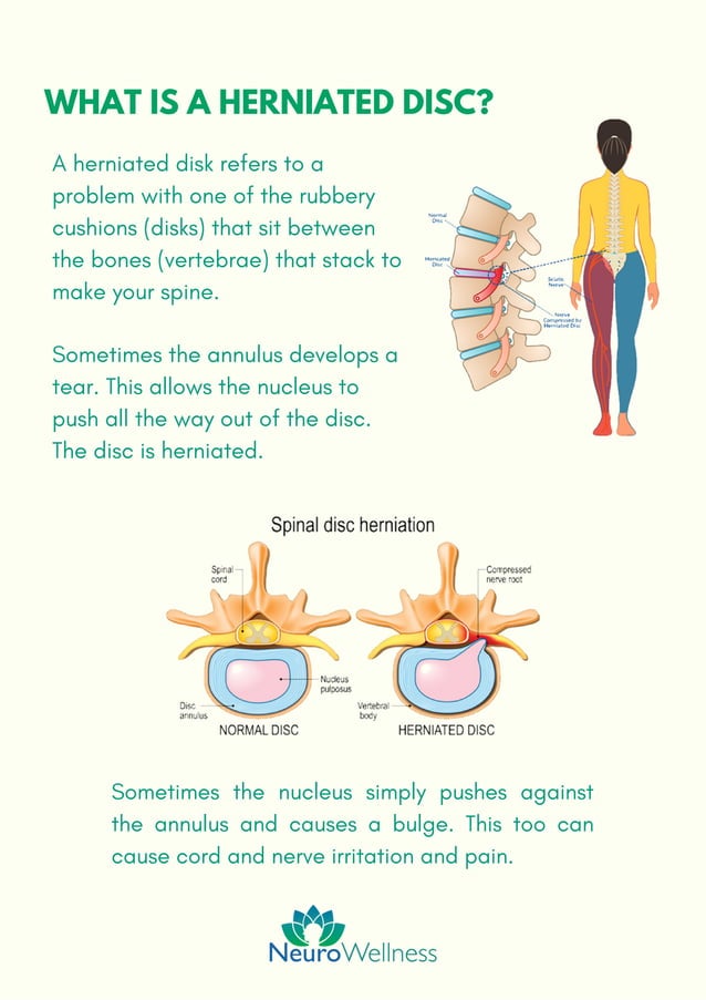 Herniated Disc Symptoms Causes PDF herniated-disc-symptoms-causes-pdf