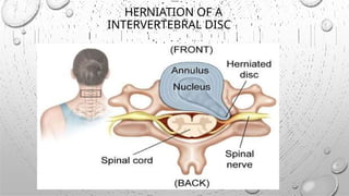 Herniation Rosh Comprehensive Overview of Intervertebral Disc Herniation: Causes ...